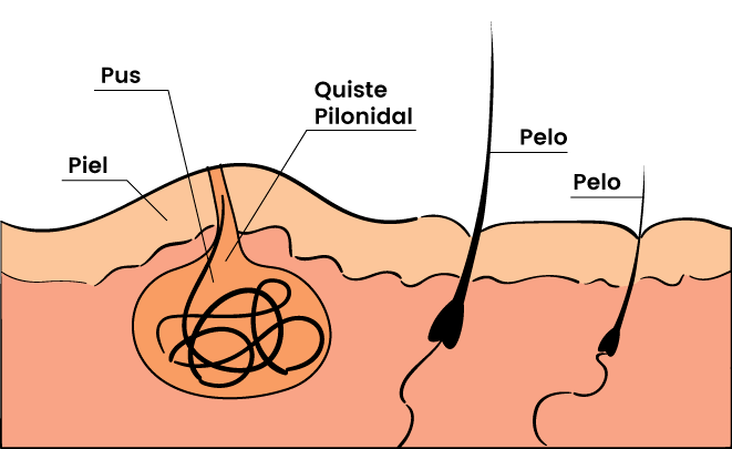 Gráfica del sinus pilonidal muestra cómo es forma un saco con restos de pelo y pues que luce inflamado y crea una protuberancia en la piel