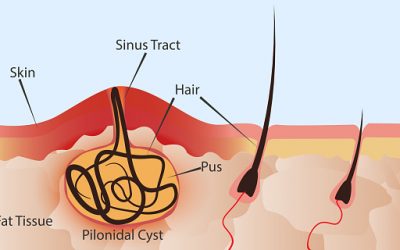 The abscess of the hair